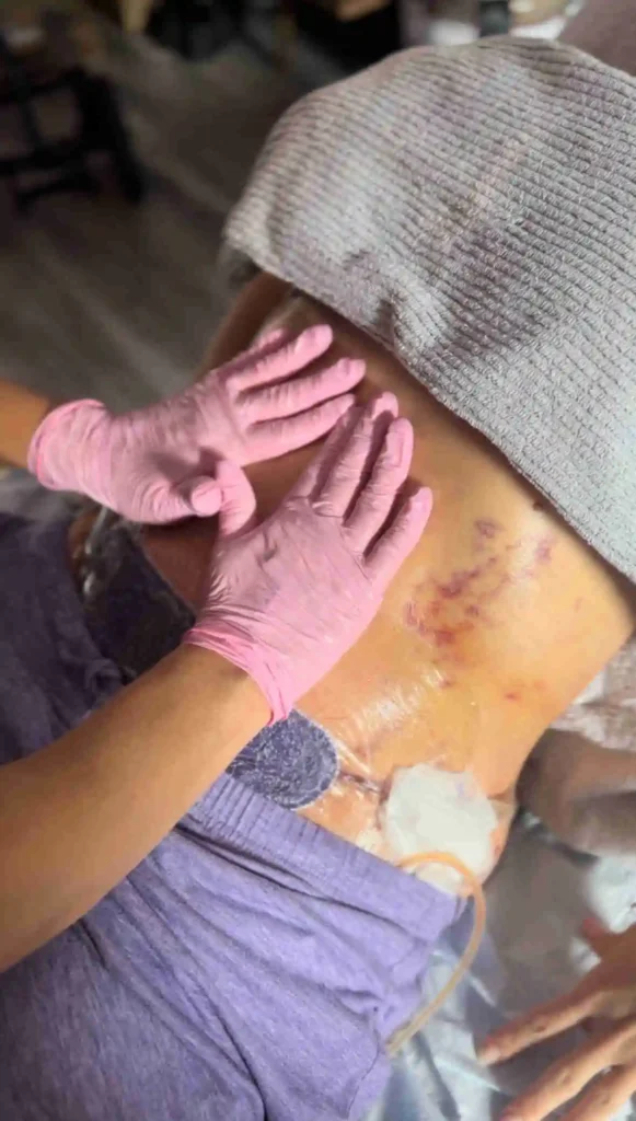 Woman Receiving Post-Surgical Lymphatic Massages | Equilibrium Lymphatic Therapy in Hollywood, FL